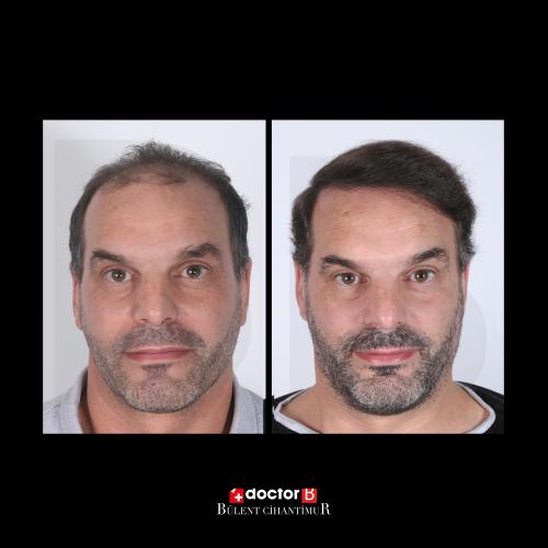 Organic hair transplantation Before / After photo